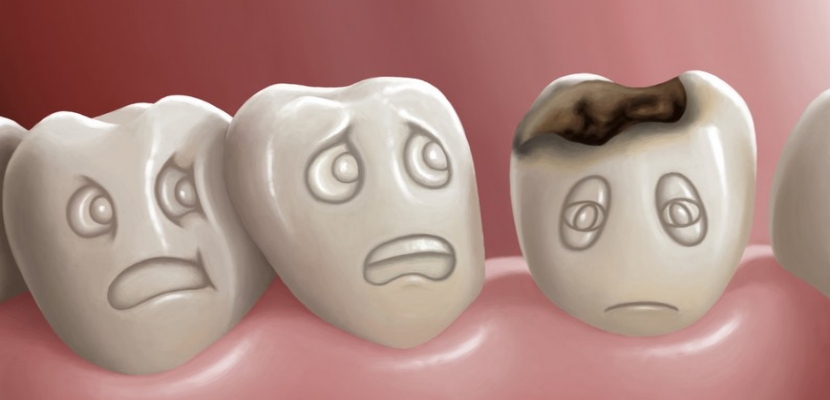 Caries Empaste Endodoncia